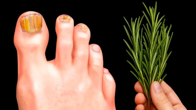 Doctors kept this secret… the fungus vanished in just one day!