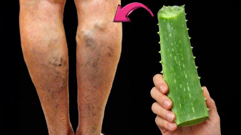 You won’t believe this simple remedy that makes varicose veins vanish…